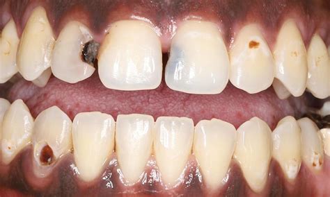 Humble Dentistrys Smile Gallery Transforming A Smile With Tooth
