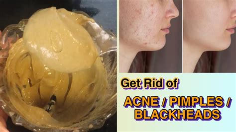 How to Remove Pimples Overnight | Acne Treatment | Get Clear Spotless