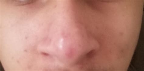 Skin Concerns Hey I Have 2 Dark Spots On The Front Of My Nose And It