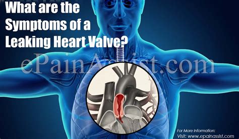 What Are The Symptoms Of A Leaking Heart Valve