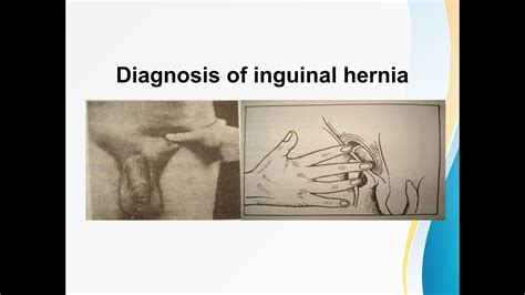 Clinical Examination And Diagnosis Of Inguino Scrotal Swellings Youtube