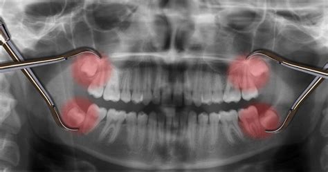 Painless Wisdom Teeth Removal Oral Surgery In Santa Clarita Valencia