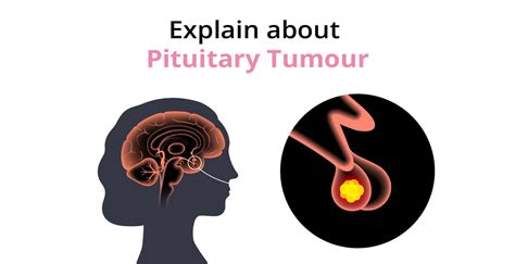 pituitary tumors causes symptoms and treatment birla fertility and ivf