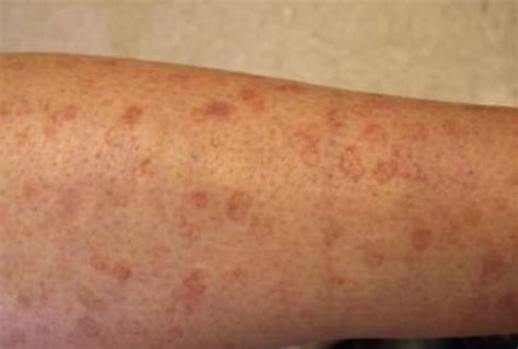 Brown Spots On Legs Are Age Spots That Are Bound To Be Found On Your