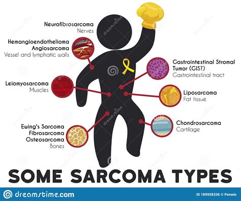 Infographic Showing Some Sarcoma Types And Principal Affected Tissues