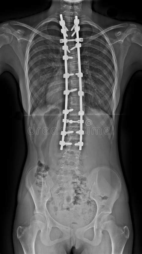 Scoliosis X Ray Radiograph Of A Whole Spine With Metallic Rods And