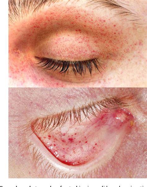 Figure 4 From Resuscitation And Conjunctival Petechial Hemorrhages