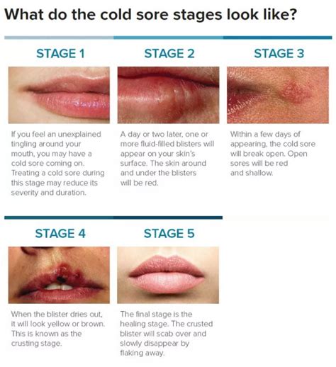 Cold Sore Stages With Pictures The Stages Of Cold Sore Outbreak