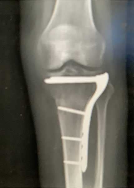 Right Tibial Plateau Fracture