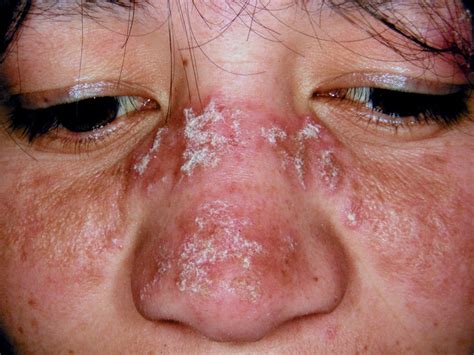 Discoid Lupus Erythematosus Primarily Affects Your Skin