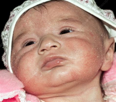 Atopic Dermatitis On Face Of A Baby Stock Image C0110345 Science