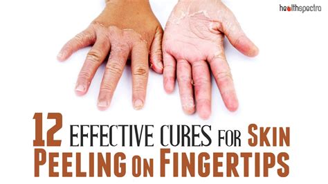 12 Effective Cures For Skin Peeling On Fingertips Healthspectra Youtube