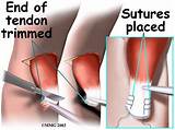 Distal Bicep Tendon Tear Recovery Time Pictures