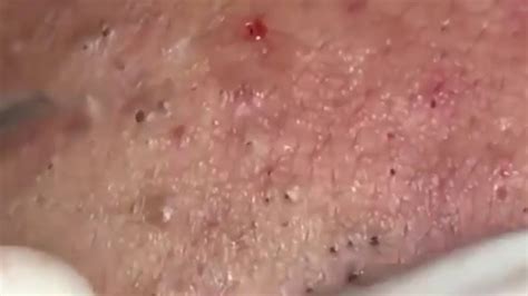 Whiteheads are generally formed due to blockage of hair follicle and skin pores with sebum or other dirt substances. How To Remove Blackheads And Whiteheads On Face Easy #76 ...