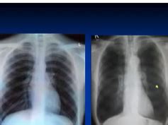 Copd Lungs Vs Normal Chest X Ray Sexiezpix Web Porn