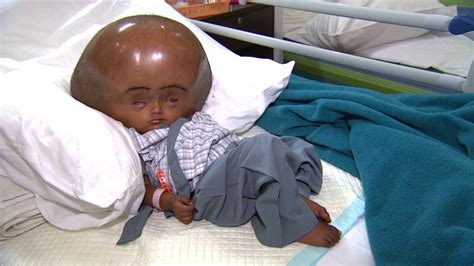 American Scientist Discovers Human With The Largest Head In The World Now Living In Finfinne