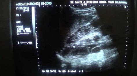 Adult Polycystic Kidneys Ultrasound Youtube