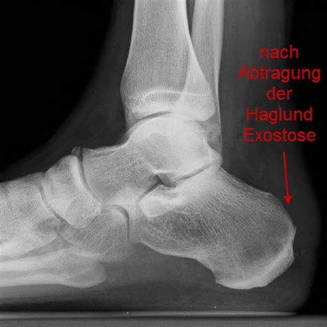 Benannt wird sie nach dem schwedischen chirurgen und orthopäden patrick haglund. Haglund-Exostose - Wuppertaler Fuß - Initiative