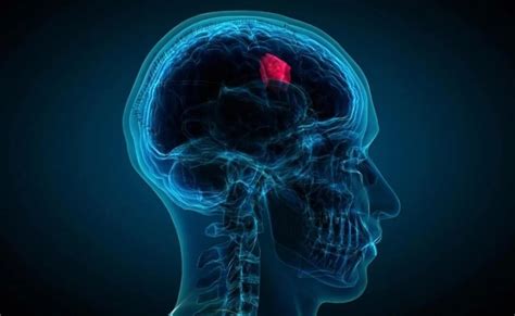 Brain Tumor Some Of The Symptoms And Signs To Look Out For