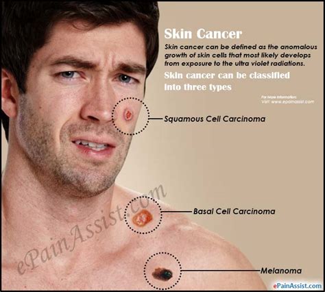 What Is Skin Cancersignssymptomsdetection And Diagnosisprevention