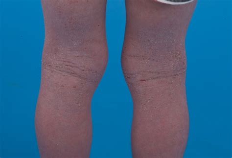 Dermatitis Behind Knees Skin And Hair Problems Articles Body And Health