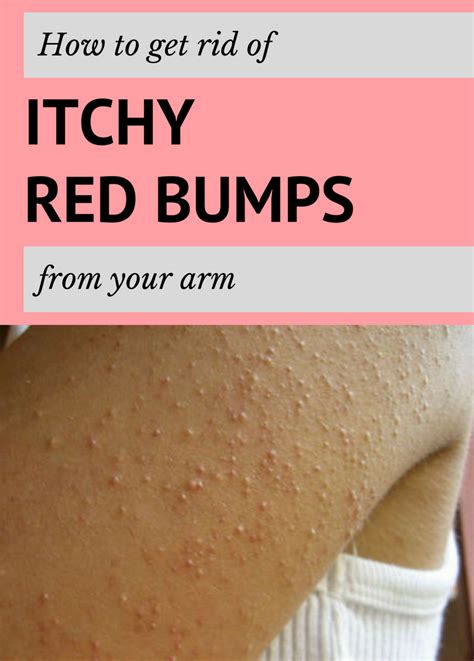 How To Get Rid Of Itchy Red Bumps From Your Arm Itchy Red Bumps Skin