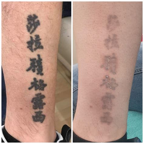 Discover 64 Tattoo Removal First Session Latest Ineteachers