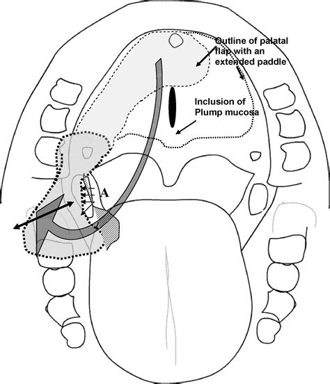 Anatomic Basis For Reconstitution Of Retromolar Region Significance Of