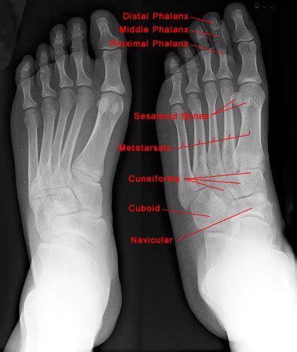 See more ideas about x ray, radiology, medical anatomy. Foot X-ray - Normal Findings | Bone and Spine