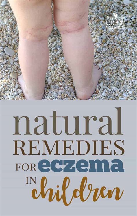 Natural Remedies For Eczema In Children Five Spot Green Living