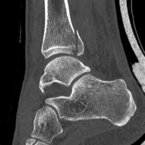 Mortise And Lateral View X Ray Of Left Ankle Mortise And Lateral View