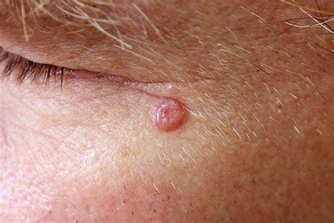 Basal Cell Carcinoma Honolulu Hi John D Boyer M D Inc