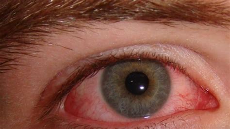 Pink Eye Now Linked As Possible Symptom Of Coronavirus Wgxa