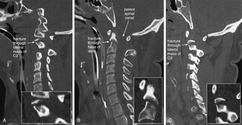 Imaging The Cervical Thoracic And Lumbar Spine Radiology Key