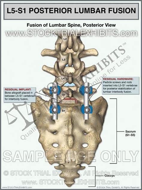 L5 S1 Lumbar Spine Fusion Posterior View Medical Malpractice Cases