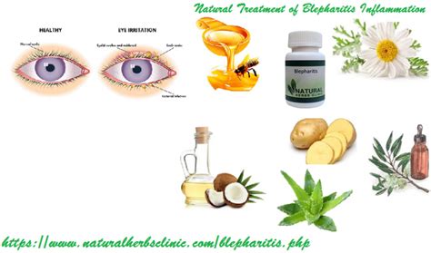 Natural Treatments Of Blepharitis Blepharitis Natural