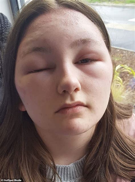 Teenager Is Blinded For Two Days After Colouring Her Hair With Garnier
