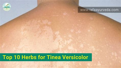 Top 10 Herbs For Tinea Versicolor Treatment
