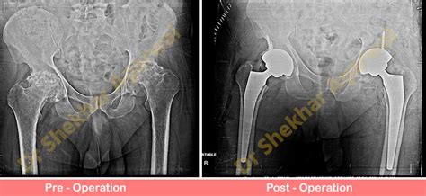 Bilateral Primary Total Hip Replacement Sant Parmanand Hospital