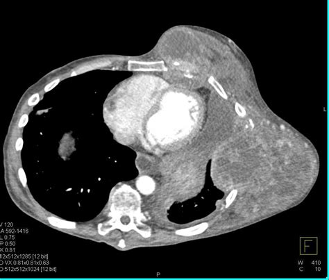 Sarcoma Involves The Chest Wall Chest Case Studies Ctisus Ct Scanning