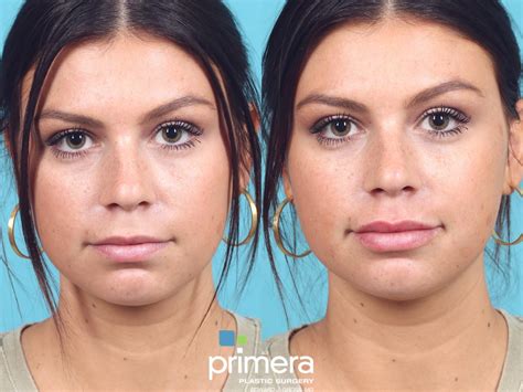 JUVÉDERM Before and After Pictures Case Orlando Florida Primera Plastic Surgery
