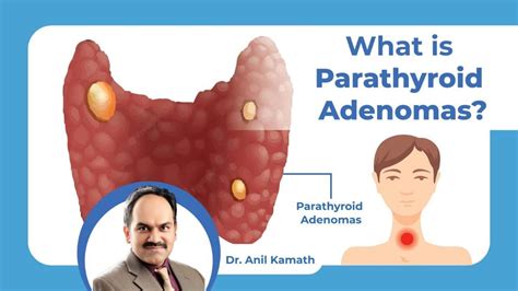 What Is Parathyroid Adenomas Symptoms And Treatment Healius Cancer