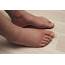 Foot Neuropathy And Leg Swelling  Nerve Renew
