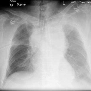 Chest X Ray Showing Endotracheal Tube Right Intercostal Drain Wide