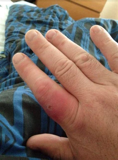 Man Nearly Loses Finger After Being Bitten By Uk Spider Uk