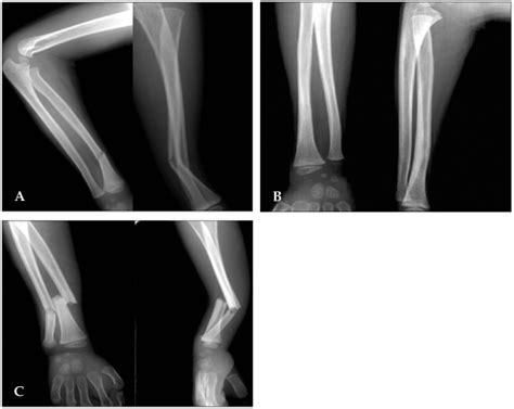 A Initial Fracture Radiograph Showing A Greenstick Fracture B