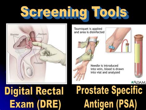 Ppt Prostate Cancer Educating Men About Informed Decision Making Powerpoint Presentation Id