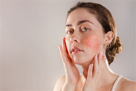 What Is Rosacea Fedhealth Medical Aid