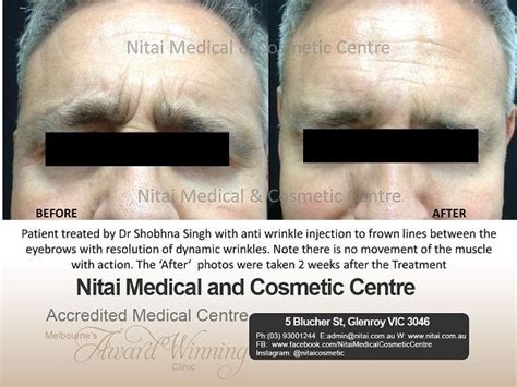 Frown Lines Treatment Before And After Images Nitai Medical And Cosmetic