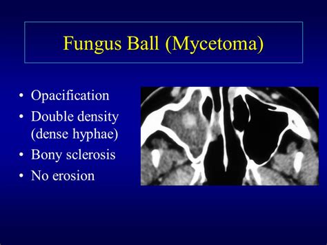 Double Density Sign In Fungal Sinusitis Fungus Balls — Fungal Hyphae Can Become Intertwined In